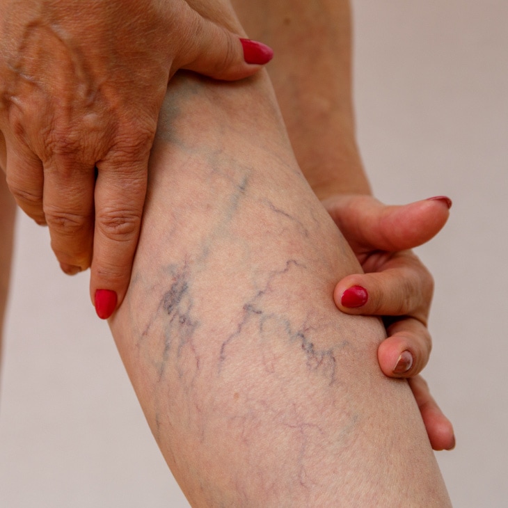 Spider Veins Treatments