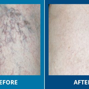 Before-After-Sclerotherapy-02-otpkbz7ec1rbxp8jd0sma2tr82n3vodhin7b5ivwzc