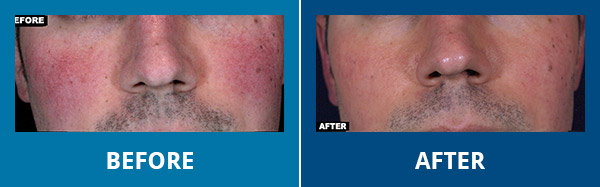 Before-After-VBeamLaser-01