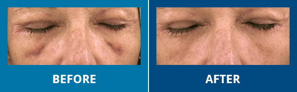 Before-After-VBeamLaser-02