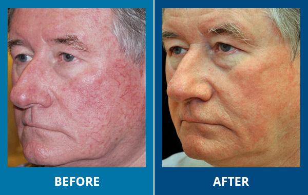 Before-After-VBeamLaser-03