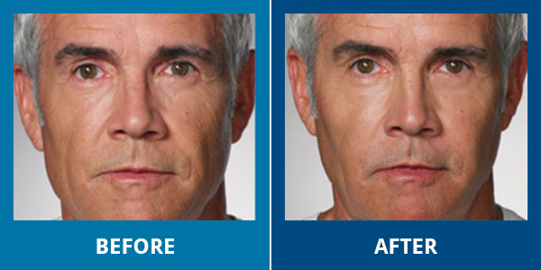 Before-After-Wrinkles-01