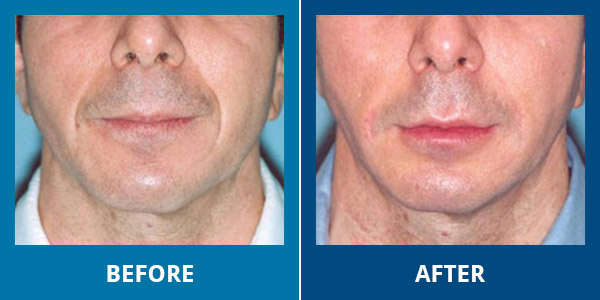 Before-After-Wrinkles-02