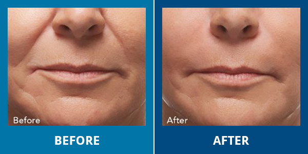 Before-After-Wrinkles-03