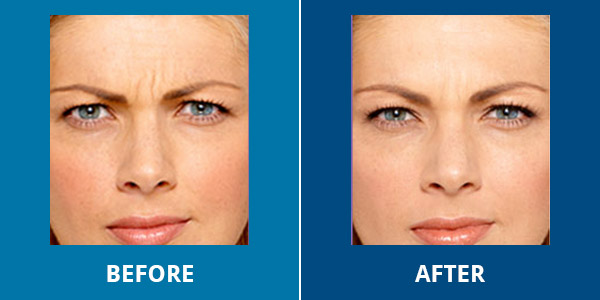 Before-After-Wrinkles-04