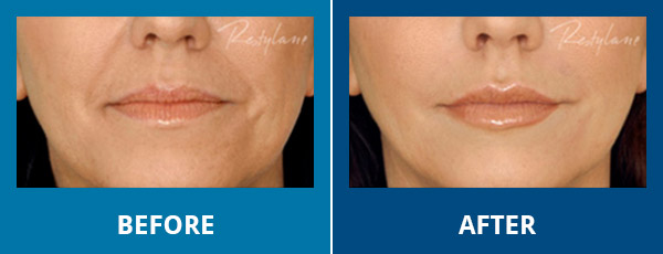 Before-After-Wrinkles-05 (1)