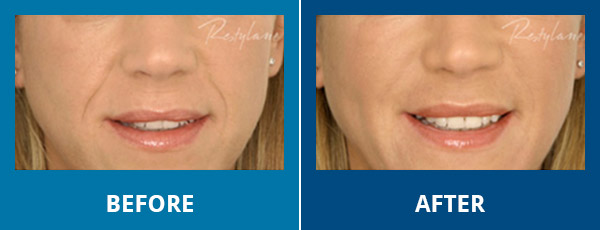 Before-After-Wrinkles-06