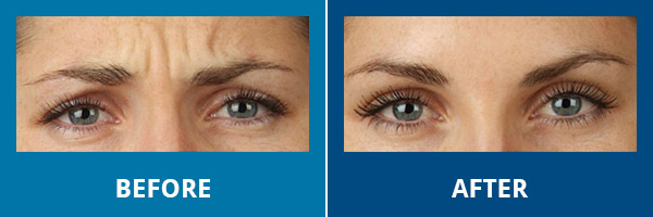 Before-After-Wrinkles-08