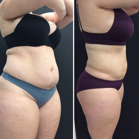 liposculture-gallery-1