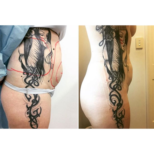 liposculture-gallery-2