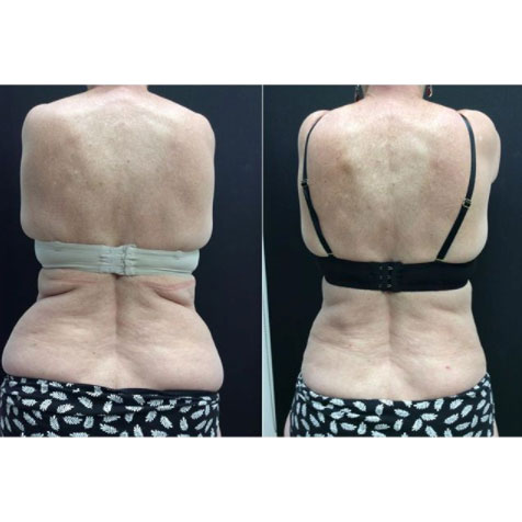 liposculture-gallery-3