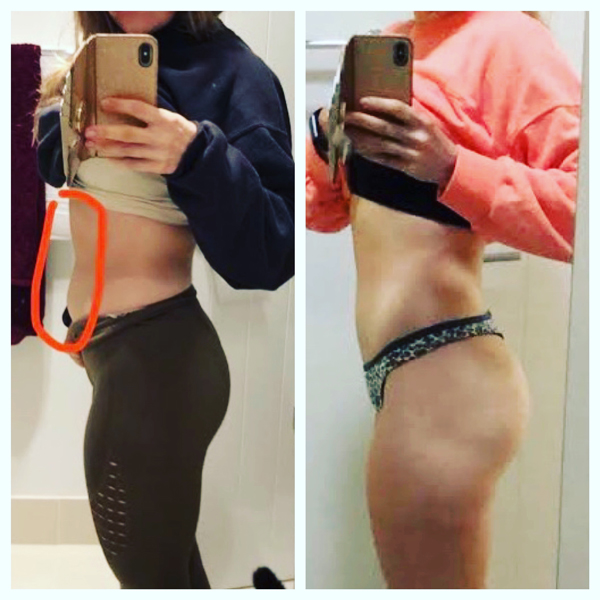 liposculture-gallery-4