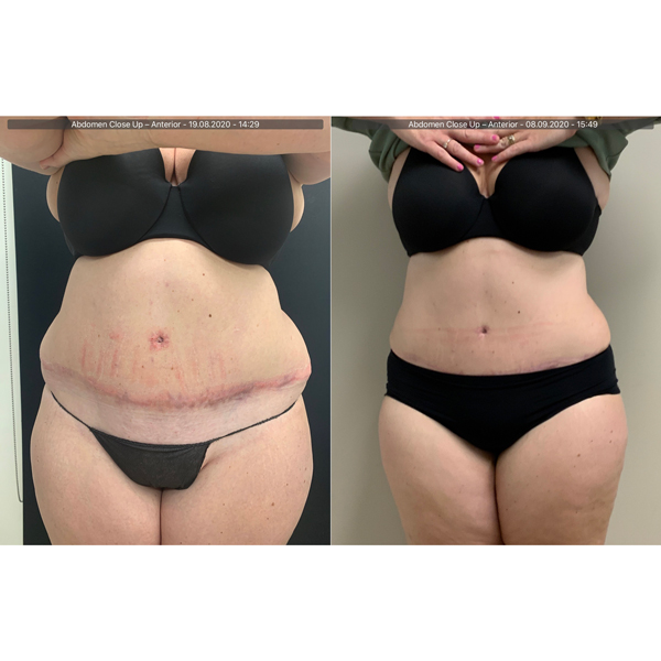 liposculture-gallery-5