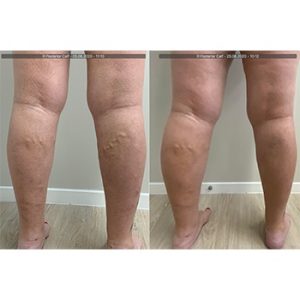 vein-gallery-legs-1-oupffpfhw504iiu6e51zv2ww45z5f5oajxvj4qxh2w (1)
