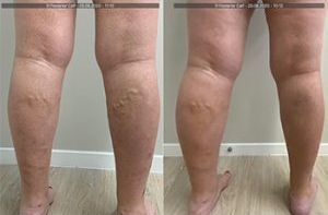 vein-gallery-legs-1-oupffpfhw504iiu6e51zv2ww45z5f5oajxvj4qxh2w (1)
