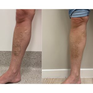vein-gallery-legs-10-ovoiy3rn34gbubb1rvwogqvthdb4lnitopjdh3skoo
