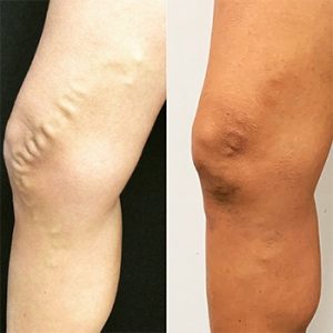 vein-gallery-legs-2-oupffrb69t2p5qrg35v902ftaxpvujvr876i3auoqg