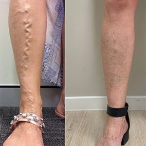 vein-gallery-legs-3-oupffs90gn3zhcq2xo9vkk79wbl928zhkbtzkktak8