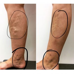 vein-gallery-legs-4-ouswr7godowox5mqe9exemaqhtd20c0qtsp9jlokhk