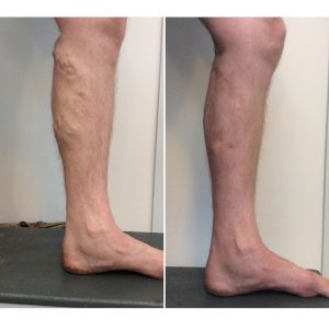 vein-gallery-legs-7-ousxrw3x3x4k1acf6m9r7v1d46jrf2nm7dagtdafnc