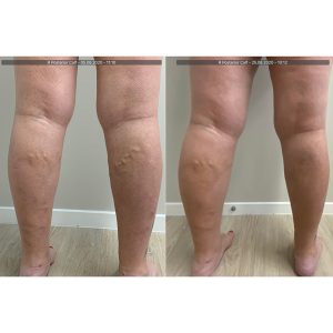 vein-gallery-legs-8-ovoixz2g4y9w89hvjbvjma2iifyaj606029y2pzjjs