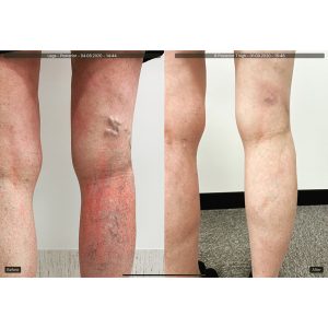 vein-gallery-legs-9-ovoiy1vypgdr73ds2v3fbrcwalke69bd0g8eijvd14