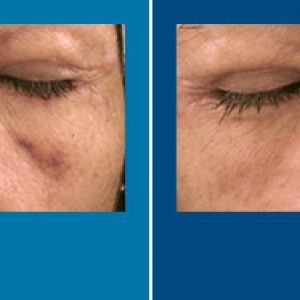 vbeam laser before and after
