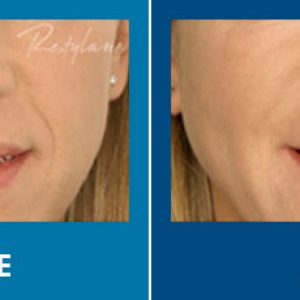 anti-wrinkle treatment before and after