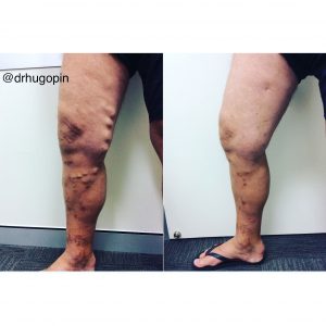 Leg Veins Before and After
