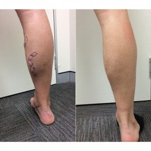 Leg Veins Before and After